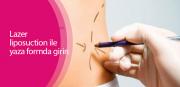 Lazer liposuction ile yaza formda girin